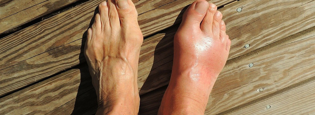 What Gout and Corona Virus Have In Common